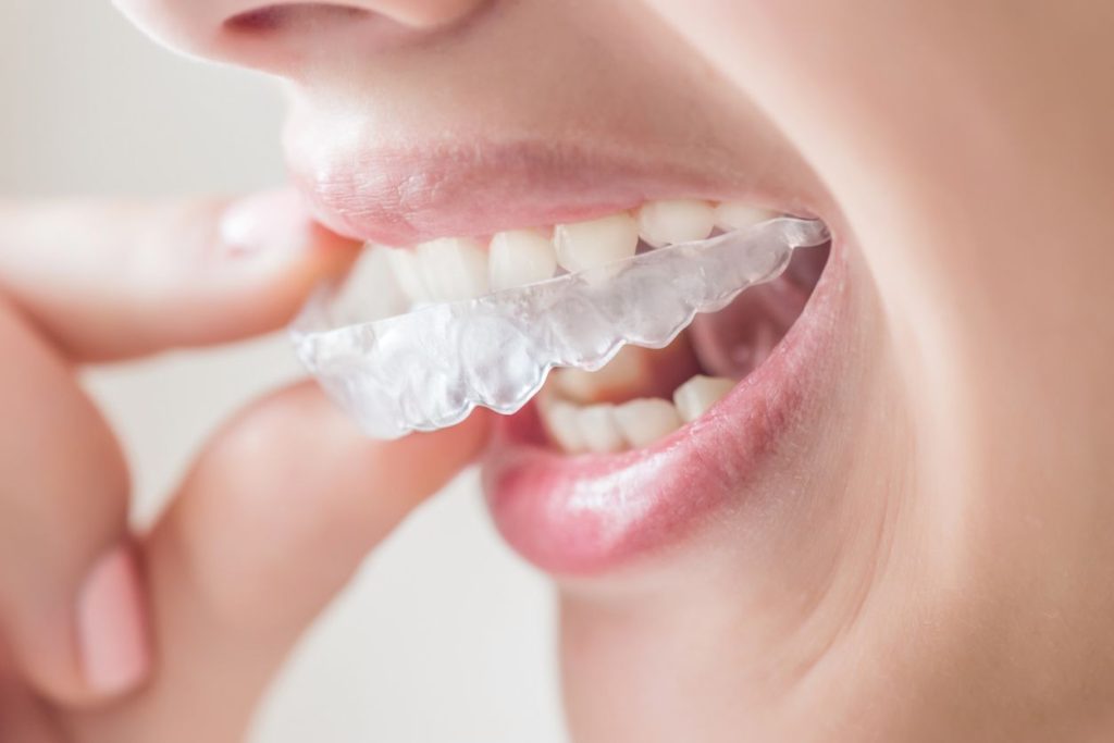 clear Invisalign aligners